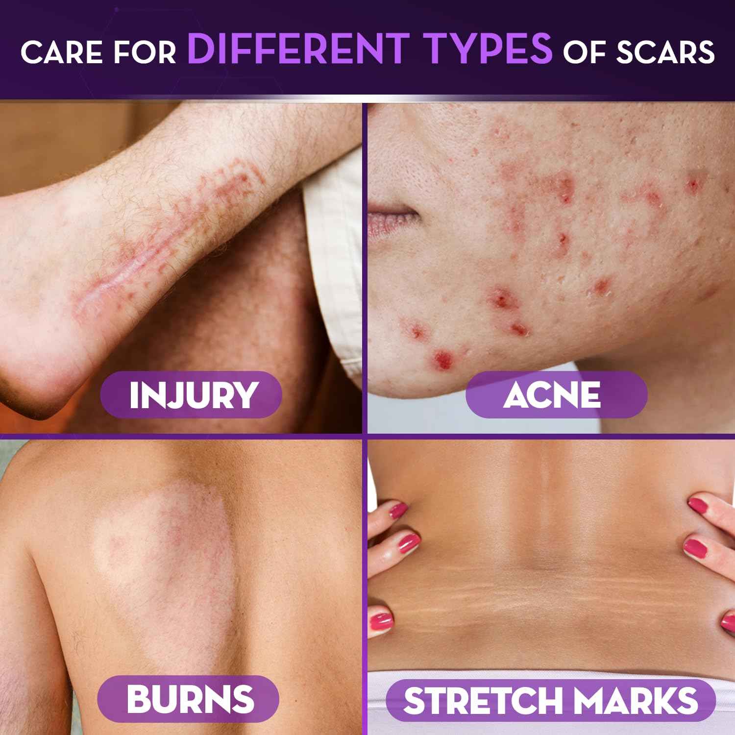 Cicatricure Advanced Scar Gel, Proven Results in 2 Weeks, 1 oz (28 g), 3pk | Scar Gel for Face & Body, Scar Treatment for Surgical Scars, Stretch Marks, Scars of Burns and Injuries, Acne Scar Treatment
