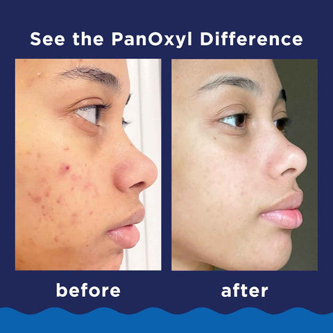 PanOxyl Acne Foaming Wash, 10% Benzoyl Peroxide, For Face & Body, 3 oz