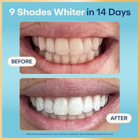 Lumineux Teeth Whitening Strips, Peroxide Free, 9 Treatments (1 Month)