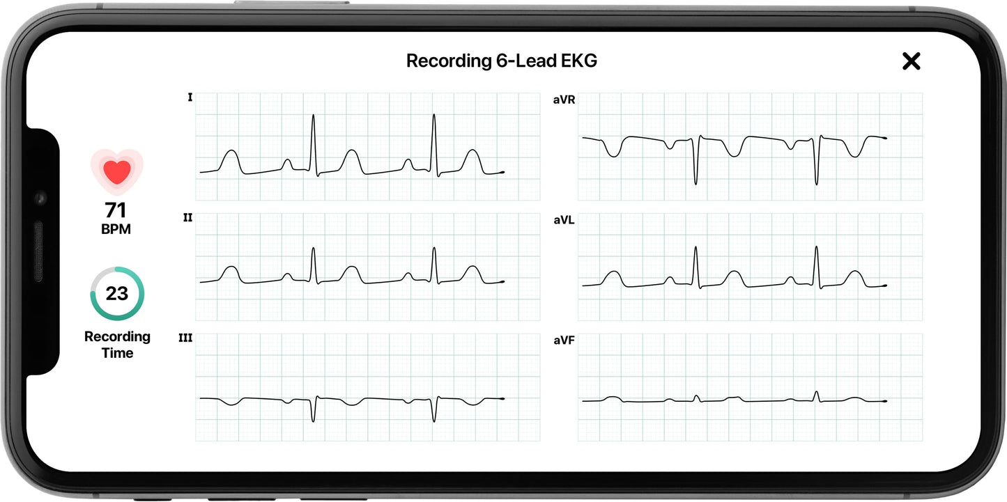 KardiaMobile 6-Lead Personal EKG Monitor – Six Views of The Heart – Detects AFib and Irregular Arrhythmias – Instant Results in 30 seconds – Works with Most Smartphones - FSA/HSA Eligible