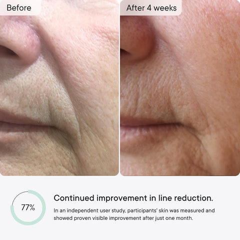 Qure Micro-Infusion Under Eye Patches for Wrinkles, Puffiness, Smile Line and Eye Bags - Retinol, Caffeine & Peptides - Made in Korea - Overnight Care, 8 Pairs (1 Month Supply)