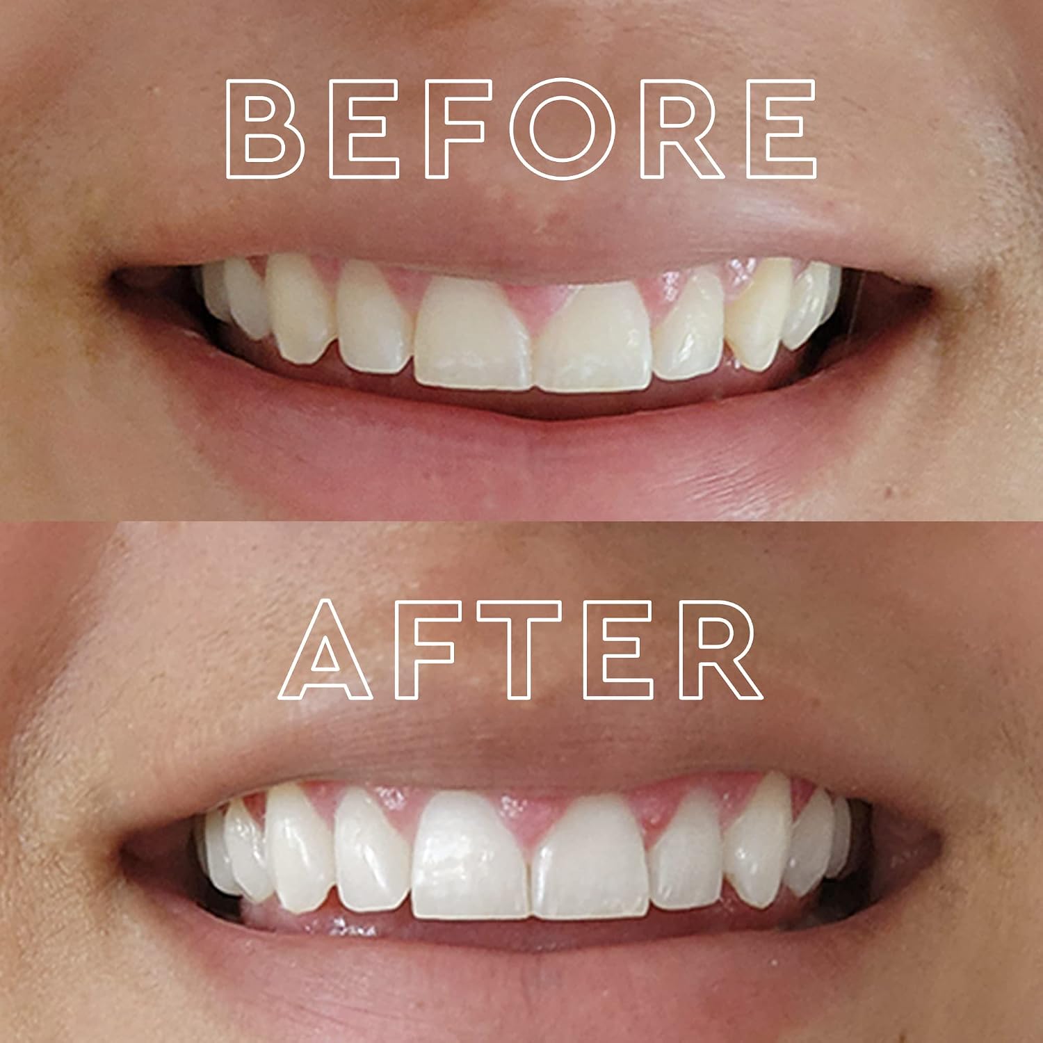 MOON Teeth Whitening Kit, LED Light Teeth Whitener Device, 56 White Strips, USB Charger & Travel Case, Blue Light Whitening Tray Removes Stains & Whitens Up to 12 Shades in 2 Weeks (4 Piece Kit)
