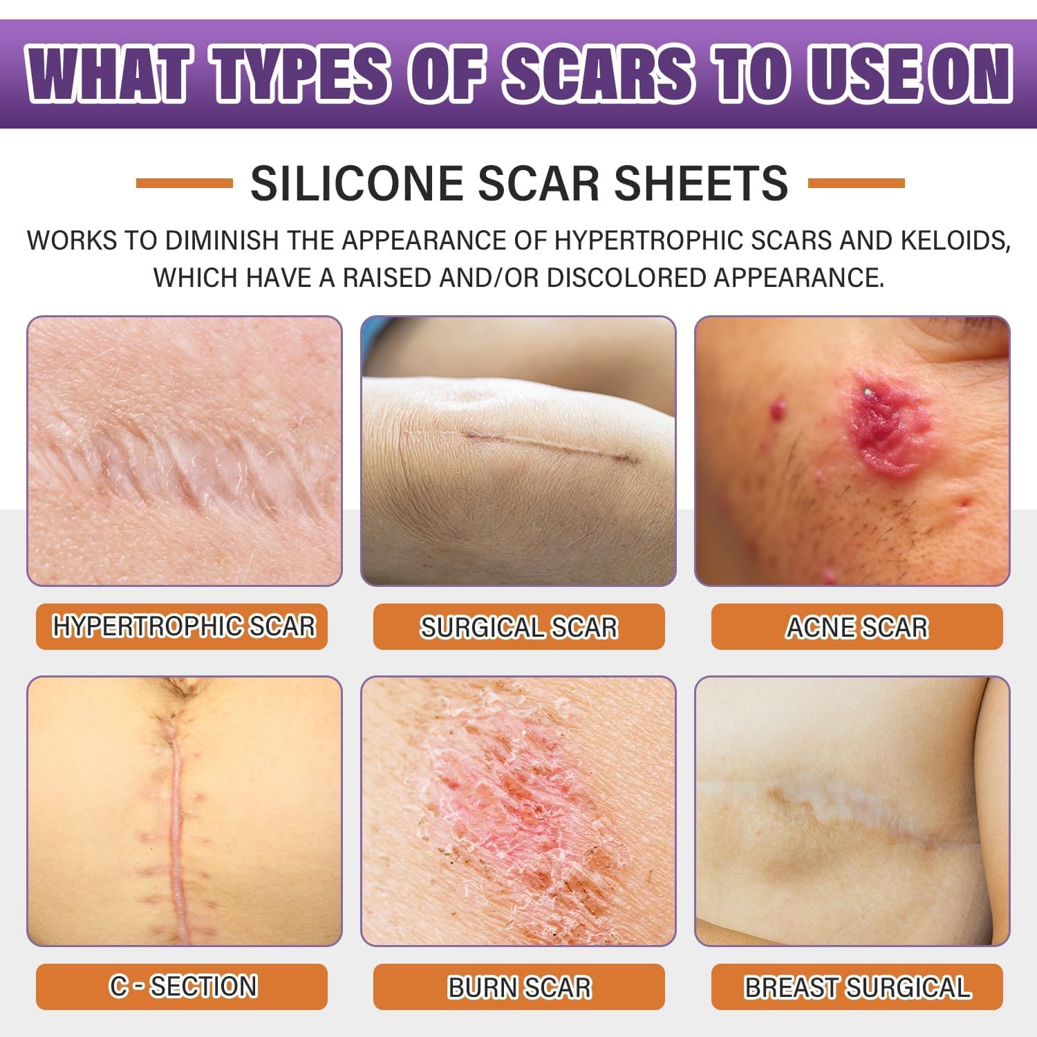Silicone Scar Sheets, Medical Grade Silicone Scar Tape for Old & New Scars