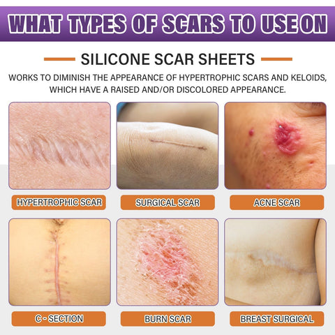 Silicone Scar Sheets, Medical Grade Silicone Scar Tape for Old & New Scars