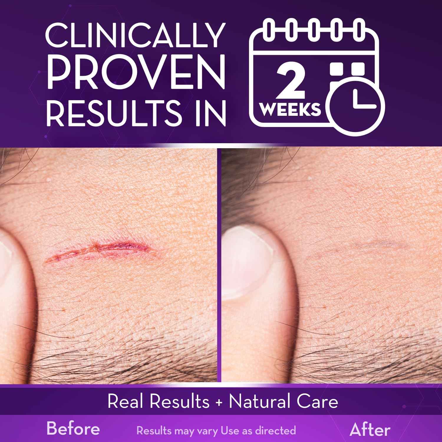 Cicatricure Advanced Scar Gel, Proven Results in 2 Weeks, 1 oz (28 g), 3pk | Scar Gel for Face & Body, Scar Treatment for Surgical Scars, Stretch Marks, Scars of Burns and Injuries, Acne Scar Treatment