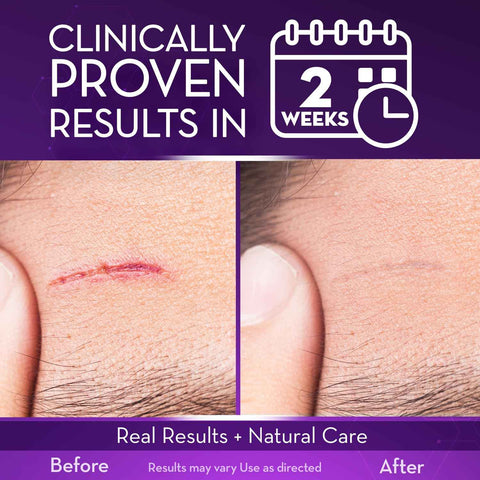 Cicatricure Advanced Scar Gel, Proven Results in 2 Weeks, 1 oz (28 g), 3pk | Scar Gel for Face & Body, Scar Treatment for Surgical Scars, Stretch Marks, Scars of Burns and Injuries, Acne Scar Treatment