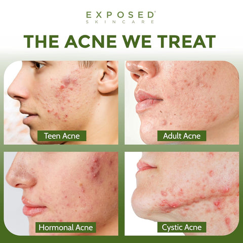 Exposed Skin Care 6-Piece Expanded Acne Treatment Kit