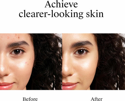 Neutrogena Rapid Clear Stubborn Acne Spot Treatment Gel, 1 oz