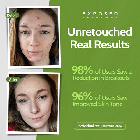 Exposed Skin Care 6-Piece Expanded Acne Treatment Kit